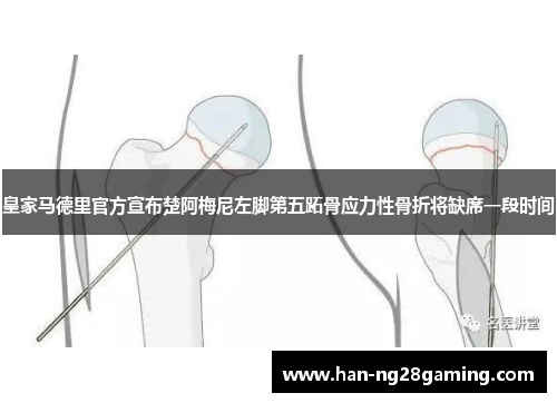 皇家马德里官方宣布楚阿梅尼左脚第五跖骨应力性骨折将缺席一段时间 皇家马德里官方宣布楚阿梅尼左脚第五跖骨应力性骨折将缺席一段时间